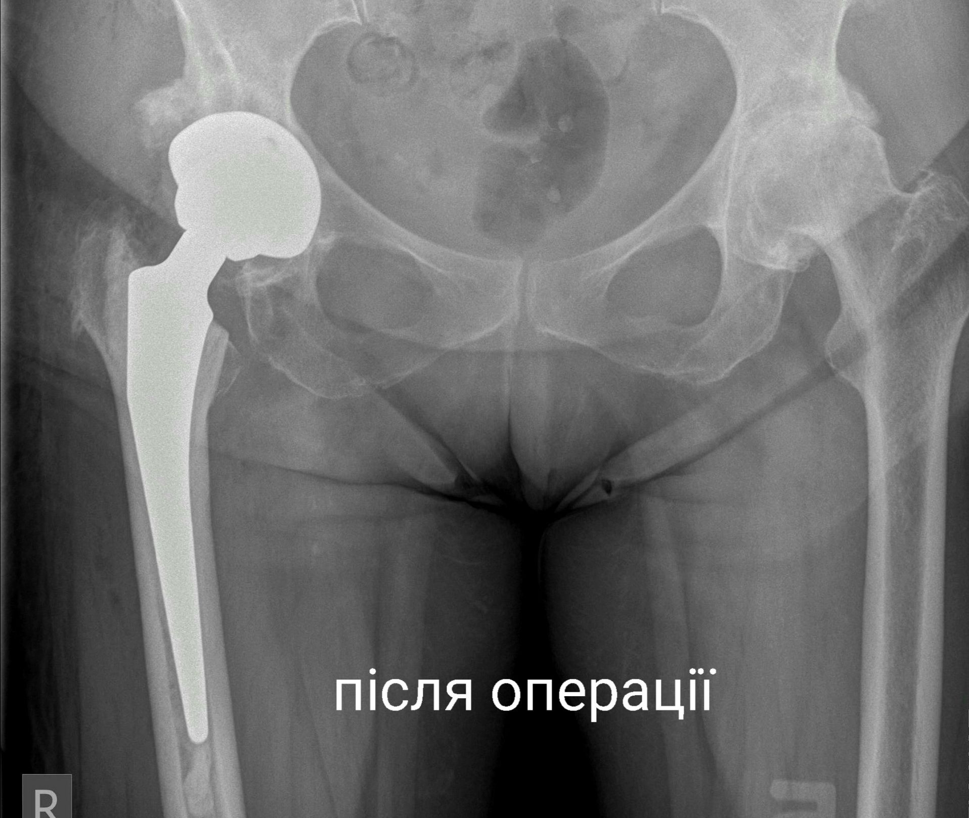 Чим відрізняється цементний протез від механічного? Відповідає хірург-ортопед Роман Горобець